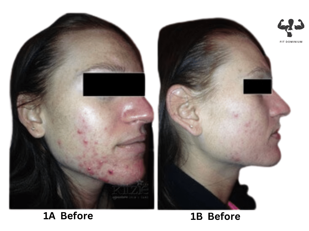 Red Light Therapy Before And After The Results Fitdominium